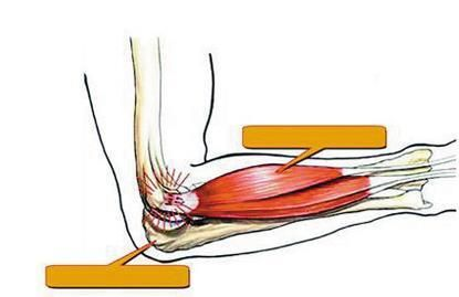 什么是网球肘？如何预防和治疗这种运动损伤？